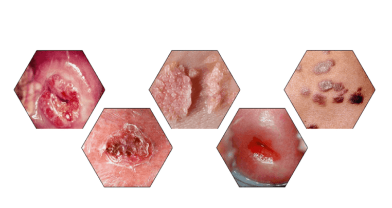 Warum Papillome gefährlich sind