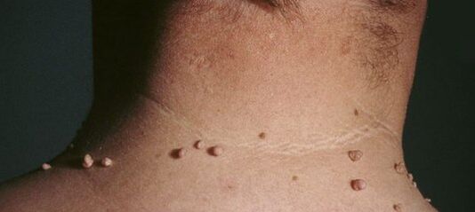 wie man Papillome loswird