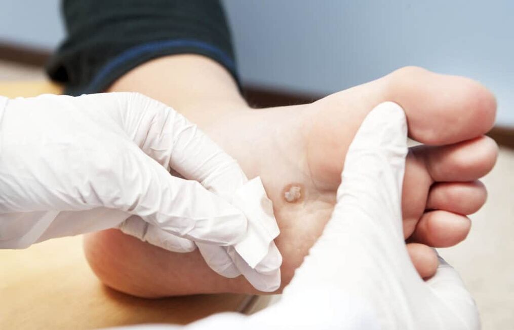 warum Warzen am Körper auftreten