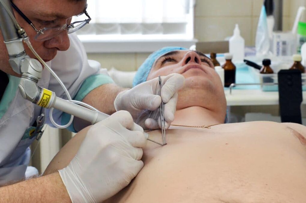 wie man Warzen am Körper loswird