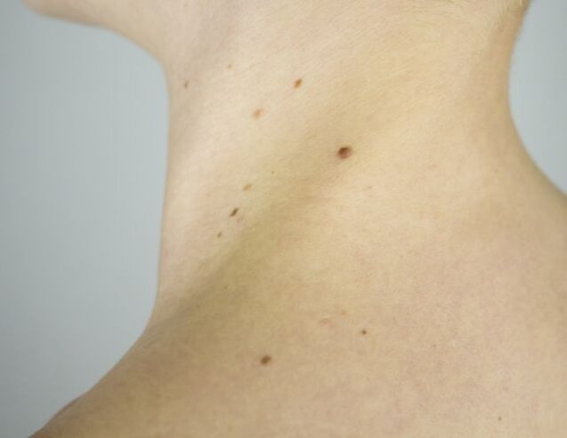 Papillome am Hals eines Mädchens