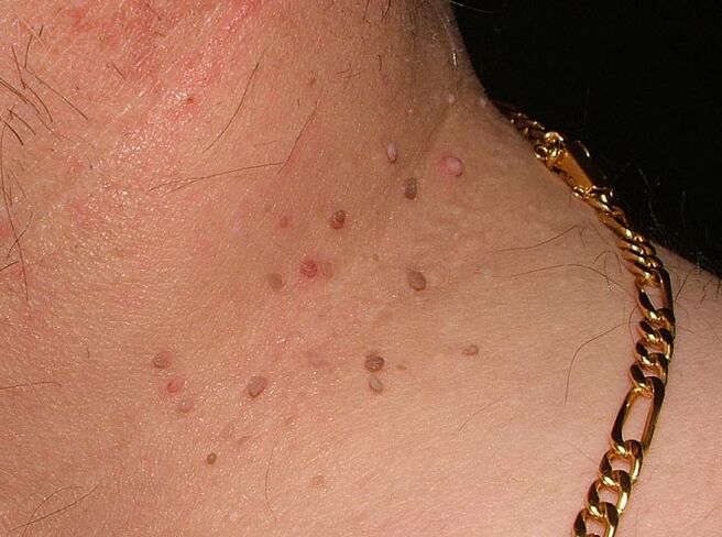 Papillome am Hals